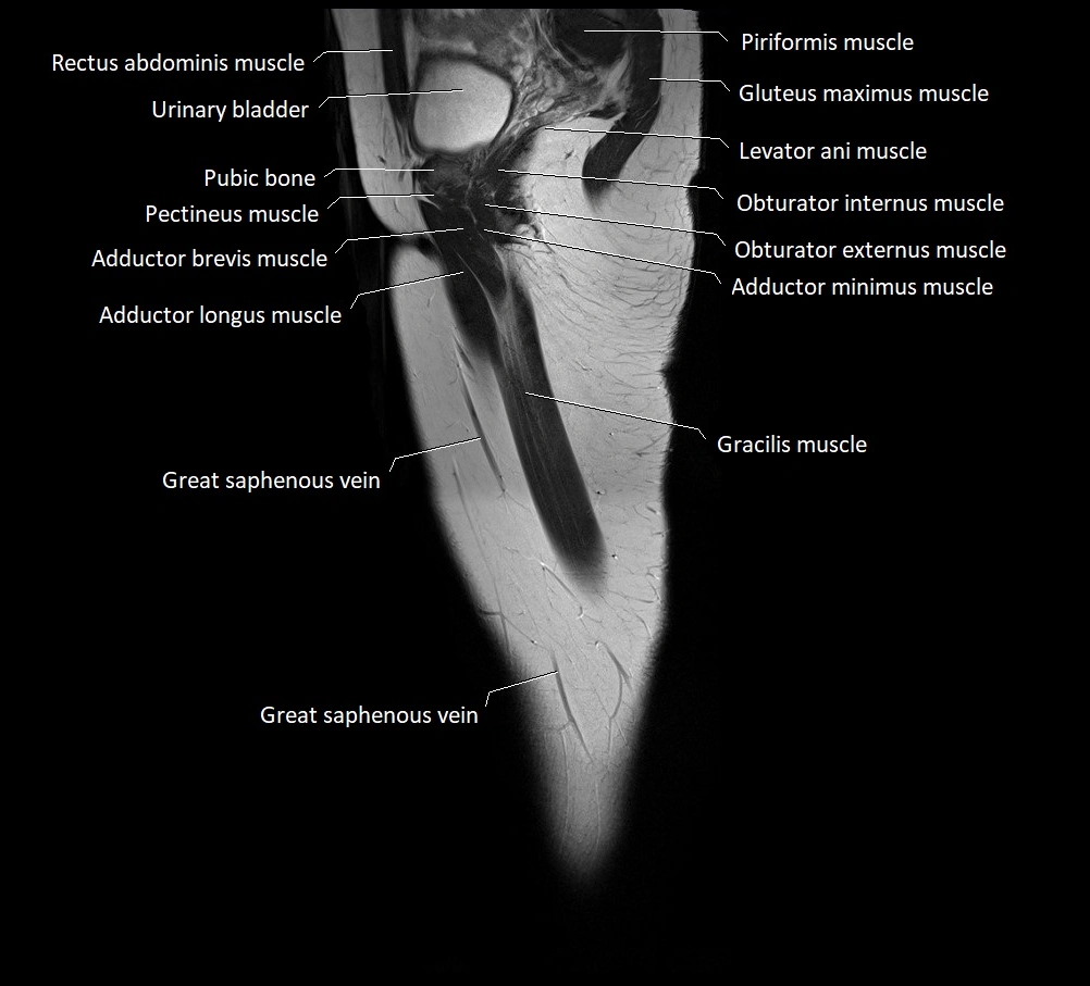 Thigh sagittal cross sectional anatomy MRI 3T image 20.webp